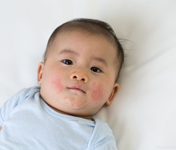 Chàm Sữa Ở Trẻ Sơ Sinh