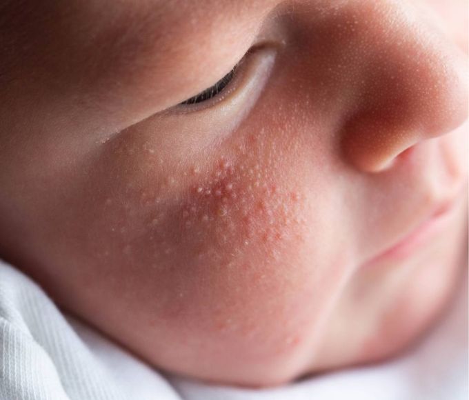 Mụn Sữa Ở Trẻ Sơ Sinh