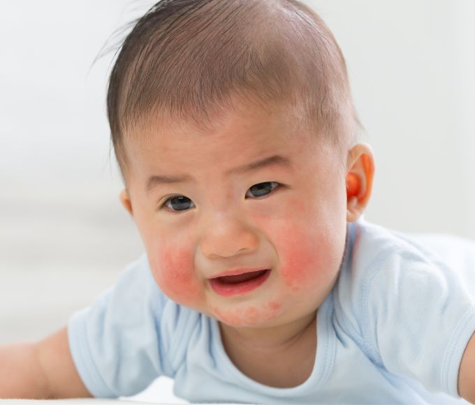 bé bị dị ứng